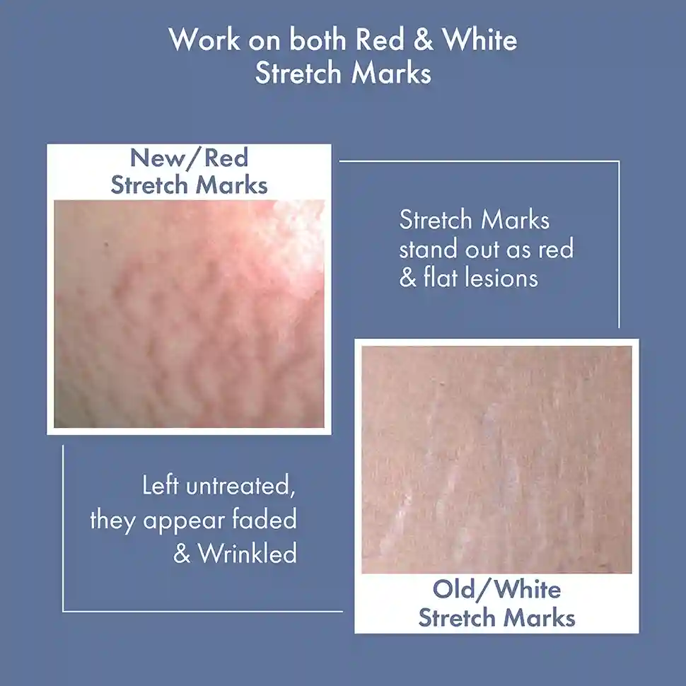 Stretch Marks Expert, Serum Cream 30ml - Image 5