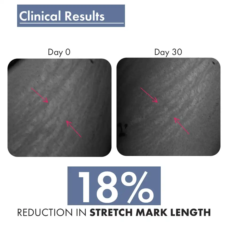 Stretch Marks Expert, Serum Cream 30ml - Image 7