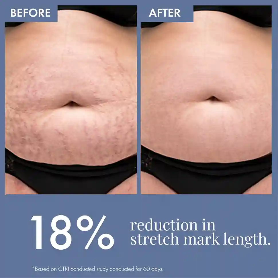 Stretch Marks Expert, Serum Cream 30ml - Image 8